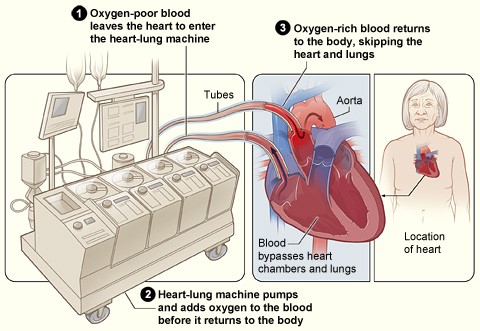 Illustration demonstrating how a heart-lung bypass machine works during surgery.